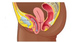 Cystocele-Cystourethrocele