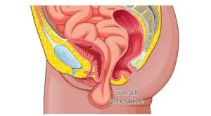 Enterocele-pelvic enterocile pelvic