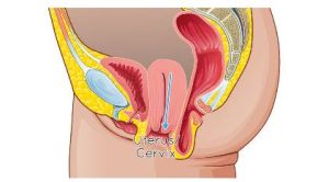 Uterine-Prolapse uterine prolapse