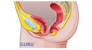 Vaginal-Vault-Prolapse vaginal vault prolapse image