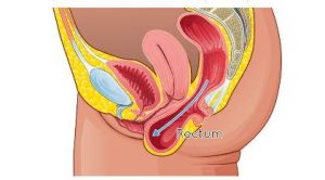 pelvic-rectocile pelvic rectocile